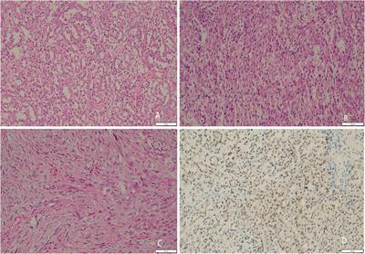 Synchronous multiple primary malignancies of clear cell renal cell carcinoma with sarcomatoid, thyroid carcinoma: a case report